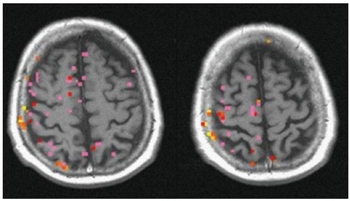 Funkční MR se statistickým hodnocením a znázorněním aktivního kortexu před výkonem – zobrazující poruchu CVR vlevo.