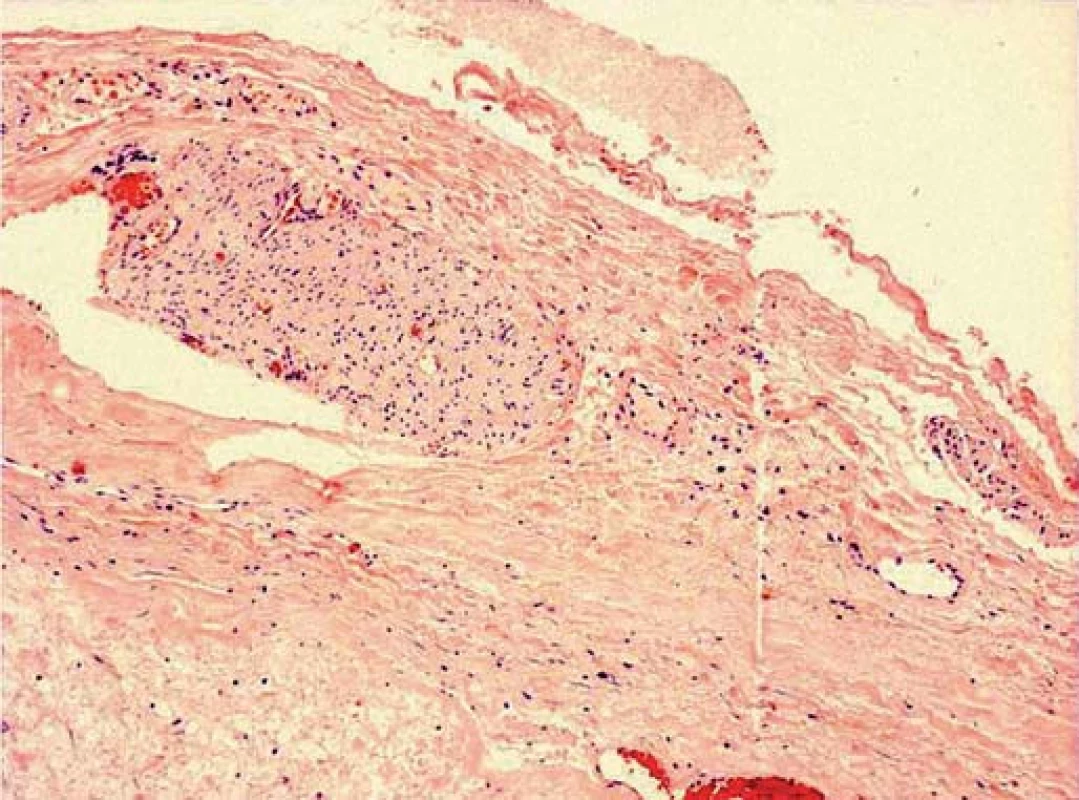 Větev periferního nervu na periferii nádoru (HE, zvětšení 100×).
Fig. 4. Peripheral nerve branch of the periphery of the tumor (HE, magnification 100×).