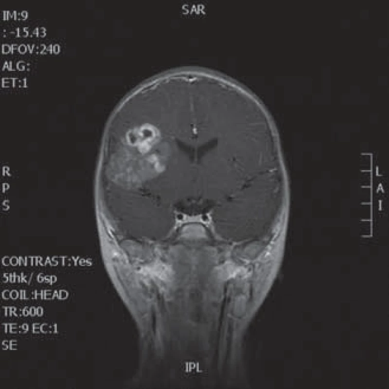MR v koronární rovině s intraaxiálním tumorem.