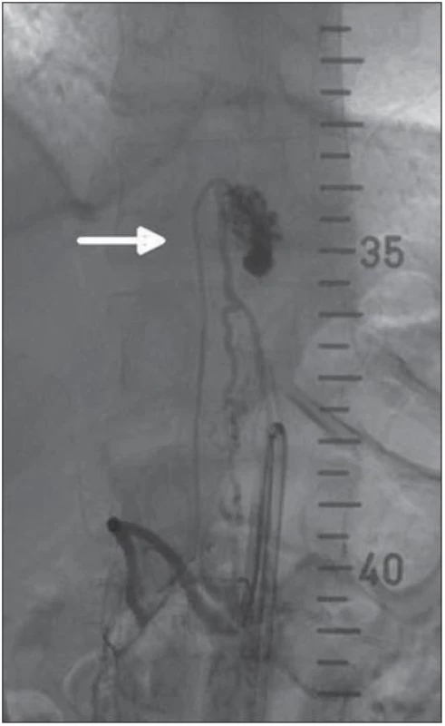 DSA – intradurální AVM v úrovni Th11/12 zásobená z a. spinalis anterior (cestou a. radicularis magna).