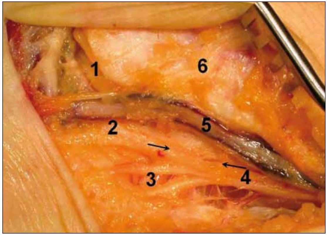 Peroperační fotografie tarzálního tunelu po discizi retinaculum flexorum vpravo u pacienta 4.
1 – n. plantaris medialis, 2 – n. plantaris lateralis, 3 – rami calcanei mediales, 4 – n. tibialis, 5 – cévní svazek, 6 – distální tibie, šipky ukazují úsek oploštění nervu