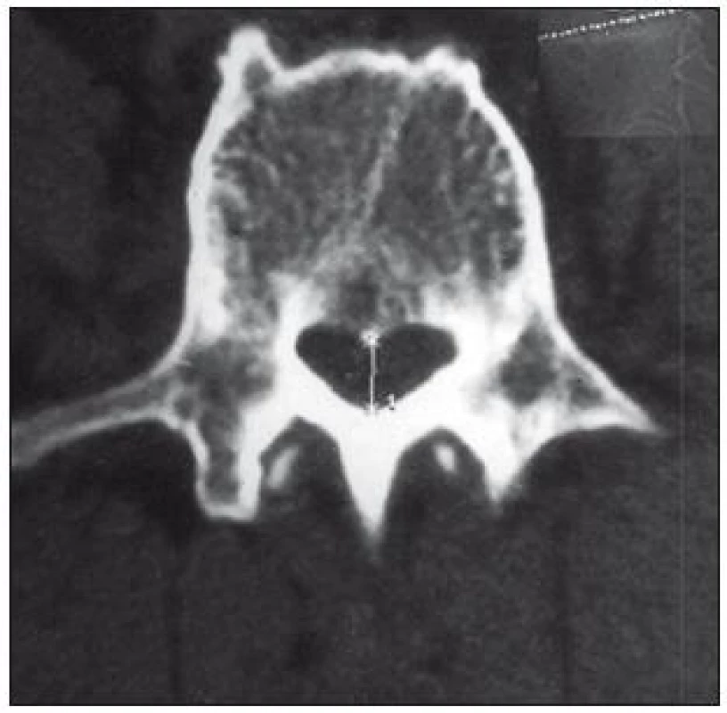 Axiální CT bederní páteře. Primární stenóza (předozadní rozměr je 9 mm).