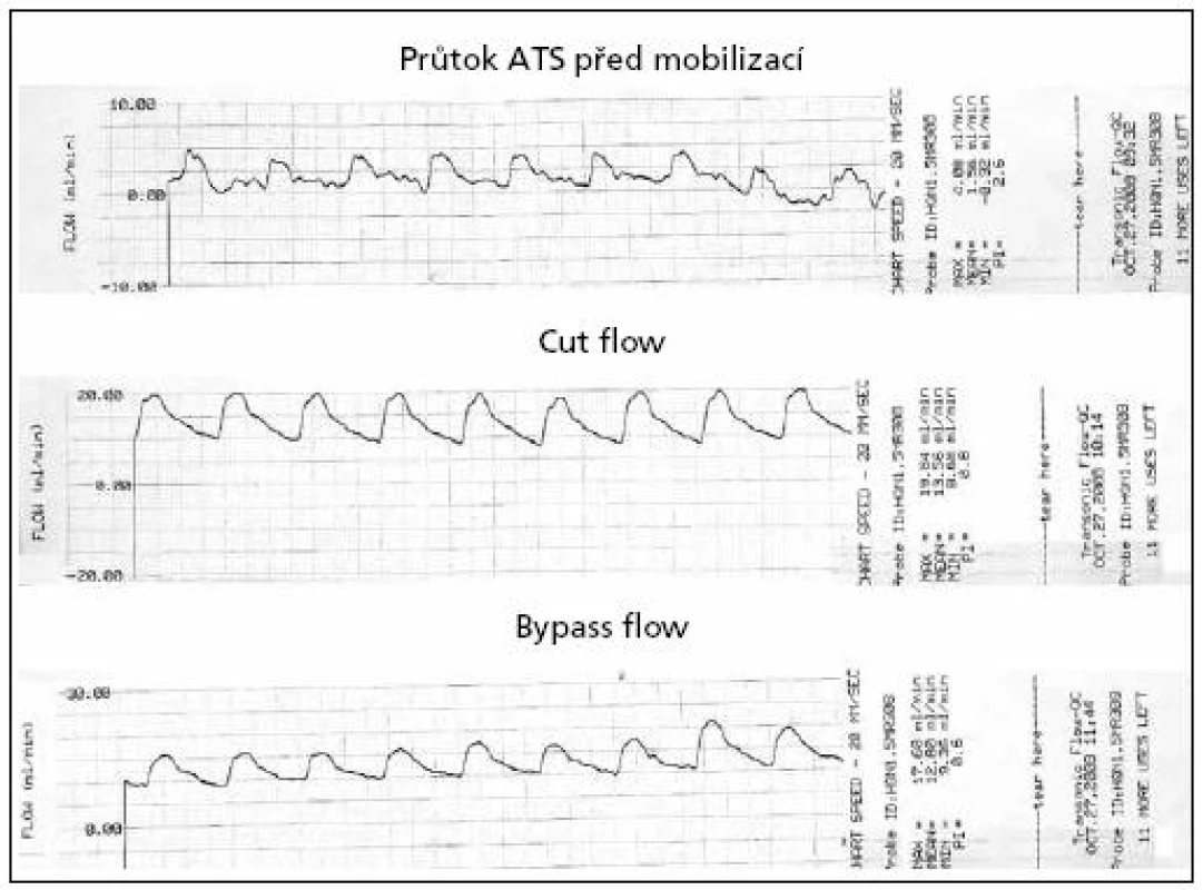 Peroperační hodnoty průtoku cévou v ml/min – výstup ultrazvukového flowmetru TTFM. Význam Cut Flow a Bypass Flow je popsán v metodice ultrazvukového vyšetření.