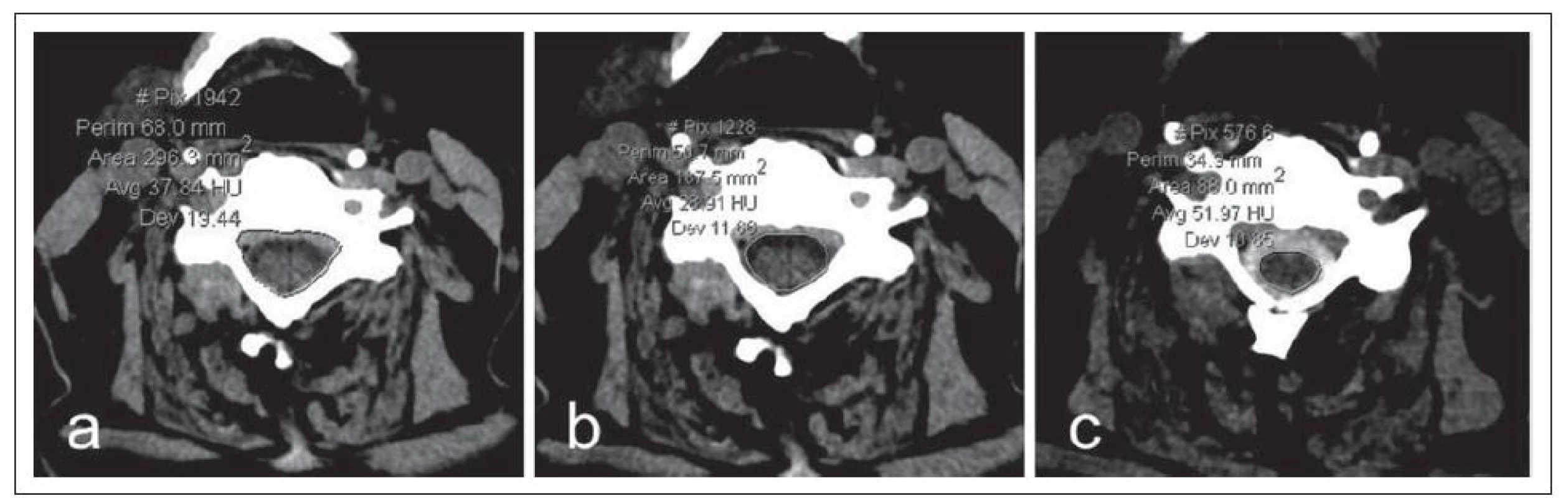 a–c) Nativní CT zobrazení krční páteře v axiální rovině (a,b) a CT myelografi e po aplikaci jodové kontrastní látky intratekálně (c).