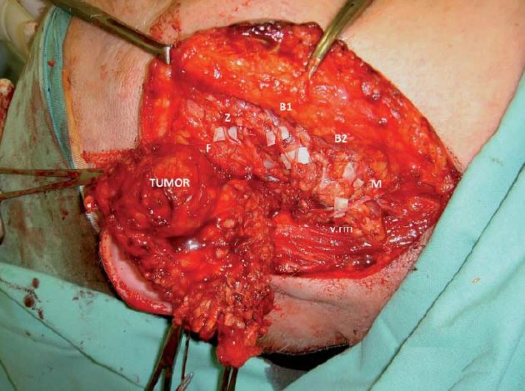 Parciální parotidektomie – peroperační snímek resekce zevního laloku parotidy v bloku s tumorem a vypreparovanou ramifikací n. VII.