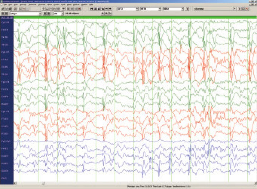 Spánkové EEG u 6letého chlapce s Landau-Kleffnerovým syndomem.
Obraz elektrického status epilepticus v NREM spánku (ESES).