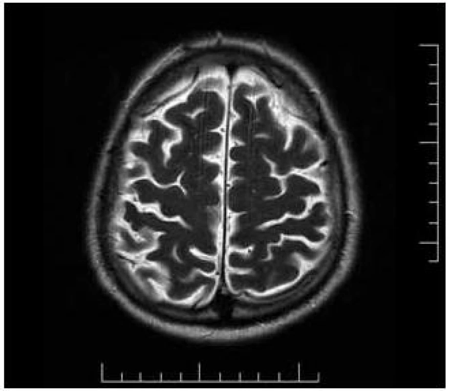 MR mozku: T2 turbo spin – echo sekvence. V transverzální rovině je patrná lehká kortikální atrofie fronto-parietální oblasti oboustranně.