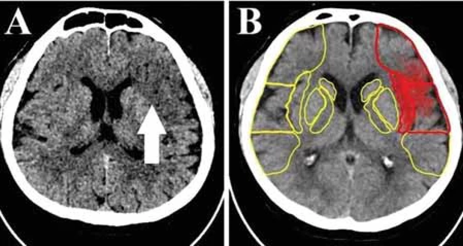 (A) Natívne vyšetrenie CT mozgu – zobrazené sú čerstvé ischemické zmeny v povodí arteria cerebral media vľavo – v oblasti inzuly, v M1 a M2 zóne (šípka). (B) Identický pacient, červenou sú označené ischemické zmeny rozpoznané softvérom umelej inteligencie e-ASPECTS Brainomix®, z natívneho vyšetrenia CT (ASPECT skóre 7).