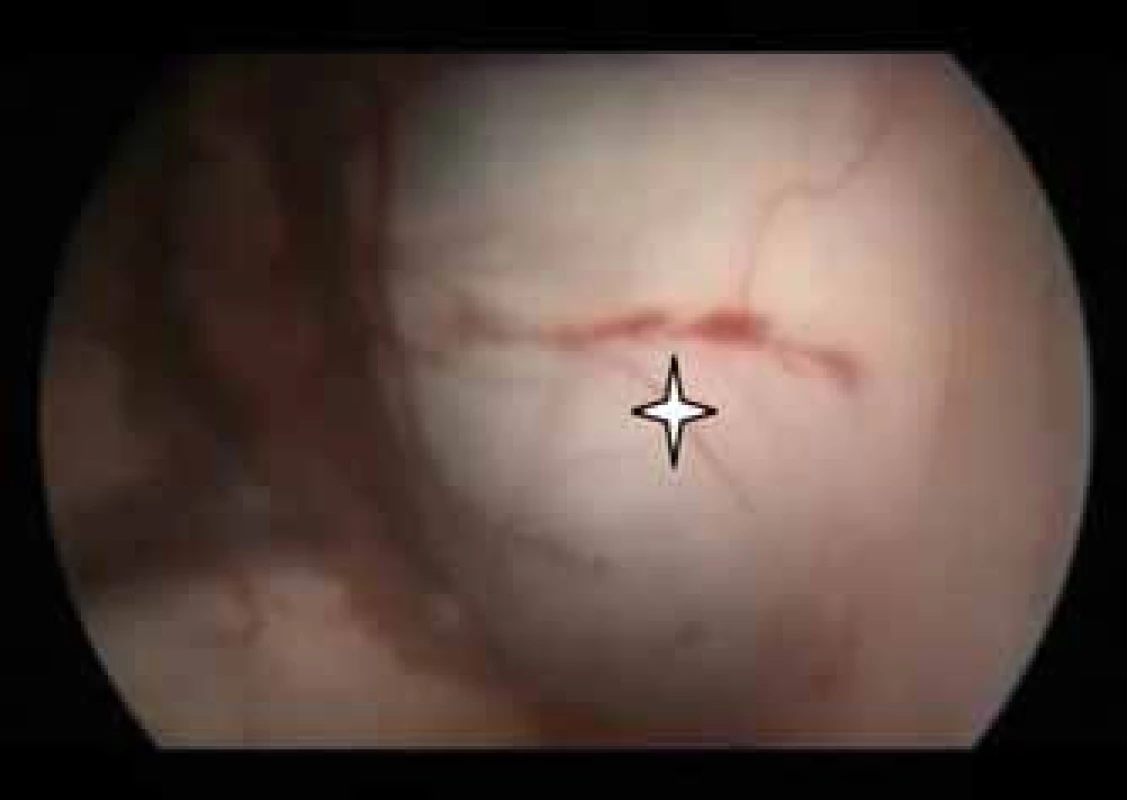 Peroperační endoskopický obraz vyklenující se cysty (*) přes foramen Monroe do postranní komory.
Fig. 2. Endoscopic view of the colloid cyst (*) bulging into the lateral ventricle via the foramen of Monro.