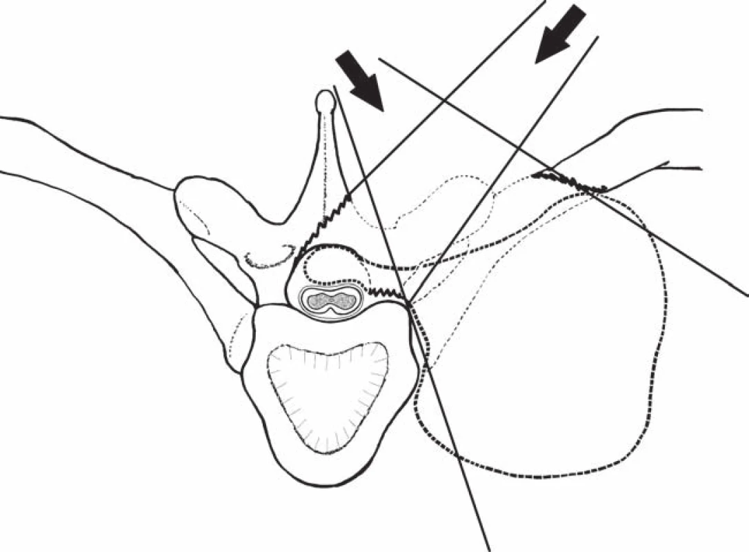 Nákres zadního operačního přístupu: hemilaminektomie s „undercuttingem“ kontralaterálně, kostotransversektomie, které umožňují pohled a bezpečný přístup k intraspinální i extraspinální části sutkovitého nádoru (axiální pohled).
Fig. 4. Posterior surgical approach: hemilaminectomia with contralateral “undercutting”, costotransversectomy that allow view and safe access to the intraspinal and extraspinal part of the dumbbell-shaped tumor (axial view).