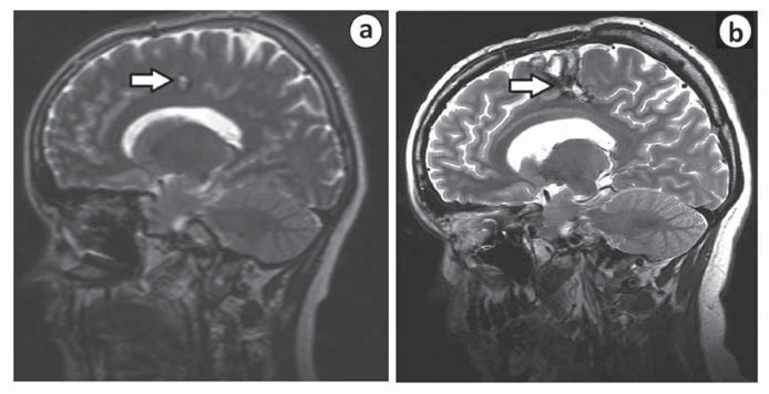MR u pacientky s pooperačním neurologickým deficitem před operací (a) a po ní (b).
