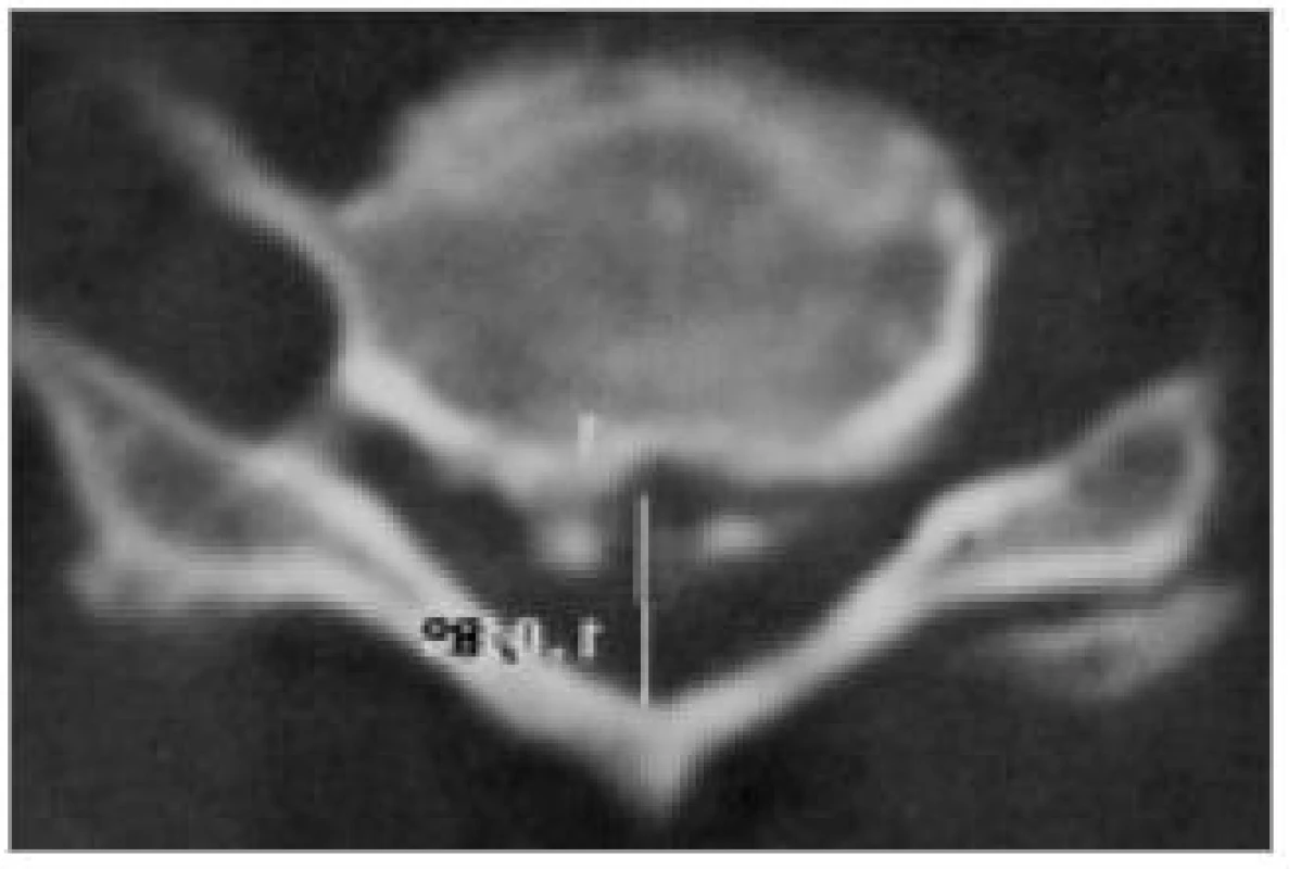 Kalcifikace v zadním podélném vazu (OPLL). CT-axiální obraz.