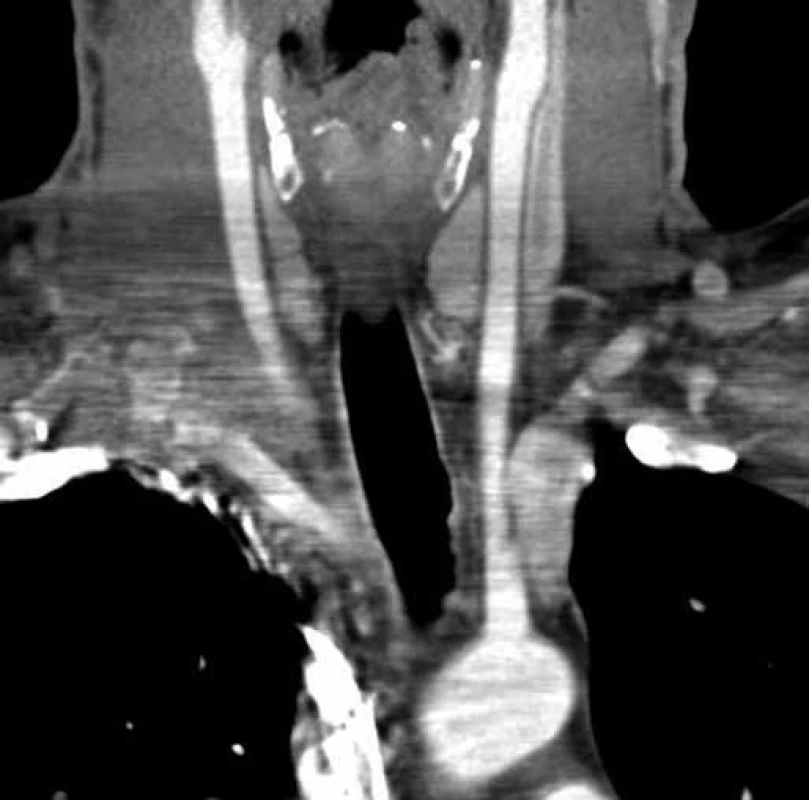 Pooperační CT angiografie.
Stav po odstranění tumoru – koronární řez.