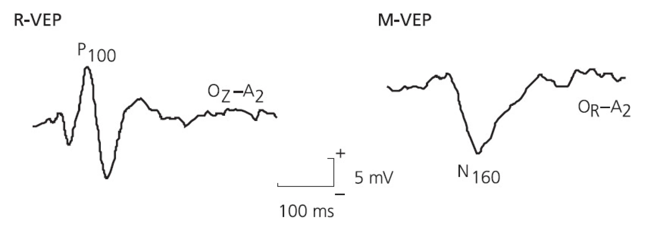 Typické příklady zrakových evokovaných odpovědí při stimulaci R-VEPs (P100 s maximem v Oz) a M-VEPs (N160 s maximem v Or nebo Ol).