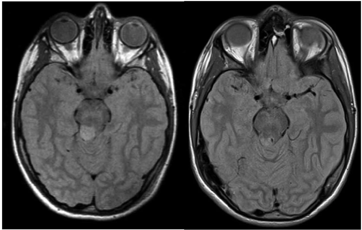 Vlevo: 10letý pacient se stereobiopticky verifikovaným astrocytomem stupeň I, velikost nádorového objemu
1 500 mm&lt;sup&gt;3&lt;/sup&gt;, minimální aplikovaná dávka 25 Gy v 5denních frakcích; vpravo: kontrolní vyšetření magnetickou rezonancí za čtyři roky, bez známek pozdní toxicity.