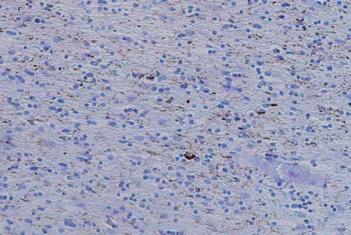 Početné neurophil threads v bílé hmotě frontálního kortexu s několika coiled bodies v imunohistochemickém barvení hyperfosforylovaným tau proteinem.
Fig. 2. Numerous neutrophil threads throughout the white matter of the frontal cortex with multiple coiled bodies in immunohistochemical staining with hyperphosphorylated tau protein.