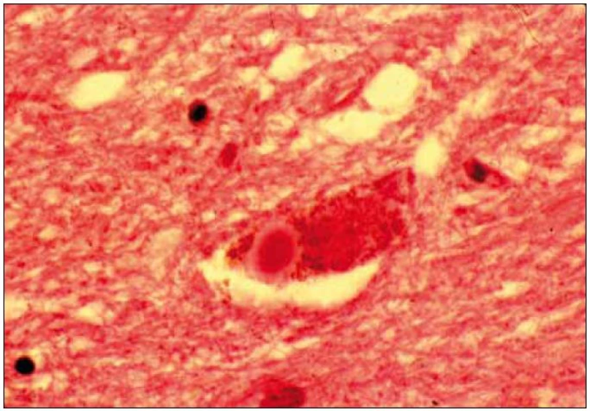 „Lewy body“ v cytoplazmě neuronu z oblasti suabstantia nigra.
Barvení hematoxilin eozin.