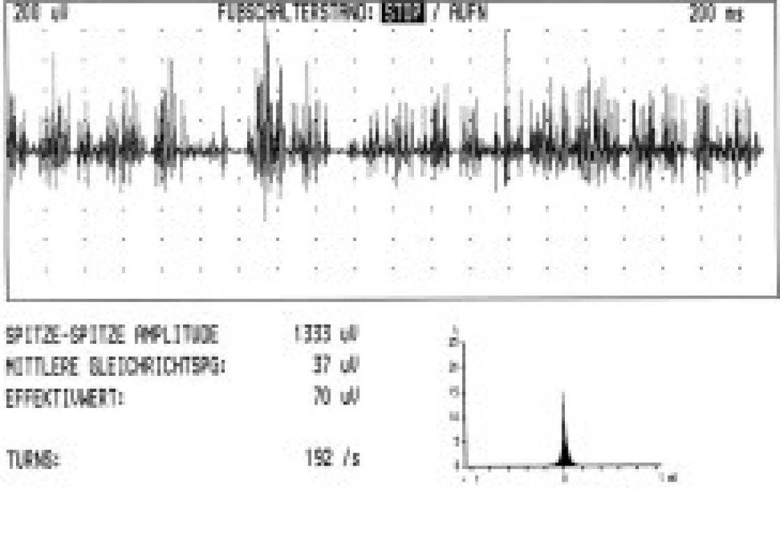 Turns/amplitude analysis u pacienta trpícího tremulózní cervikální dystonií (pravostrannou torticollis), záznamz m. splenius capitis vpravo, počet turns/sekunda 192.