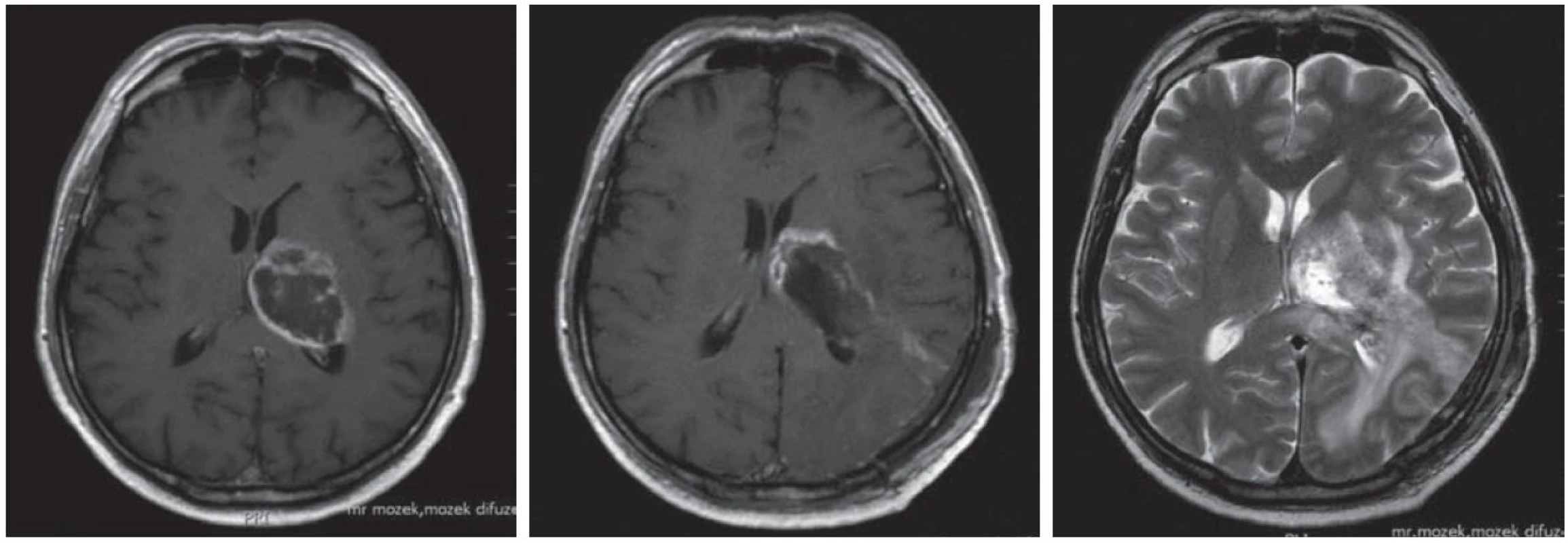 Pacient (61 let) po subtotální exstirpaci glioblastomu levého thalamu (vlevo před operací T1 s kontrastem, uprostřed po operaci T1 s kontrastem, vpravo po operaci T2).
