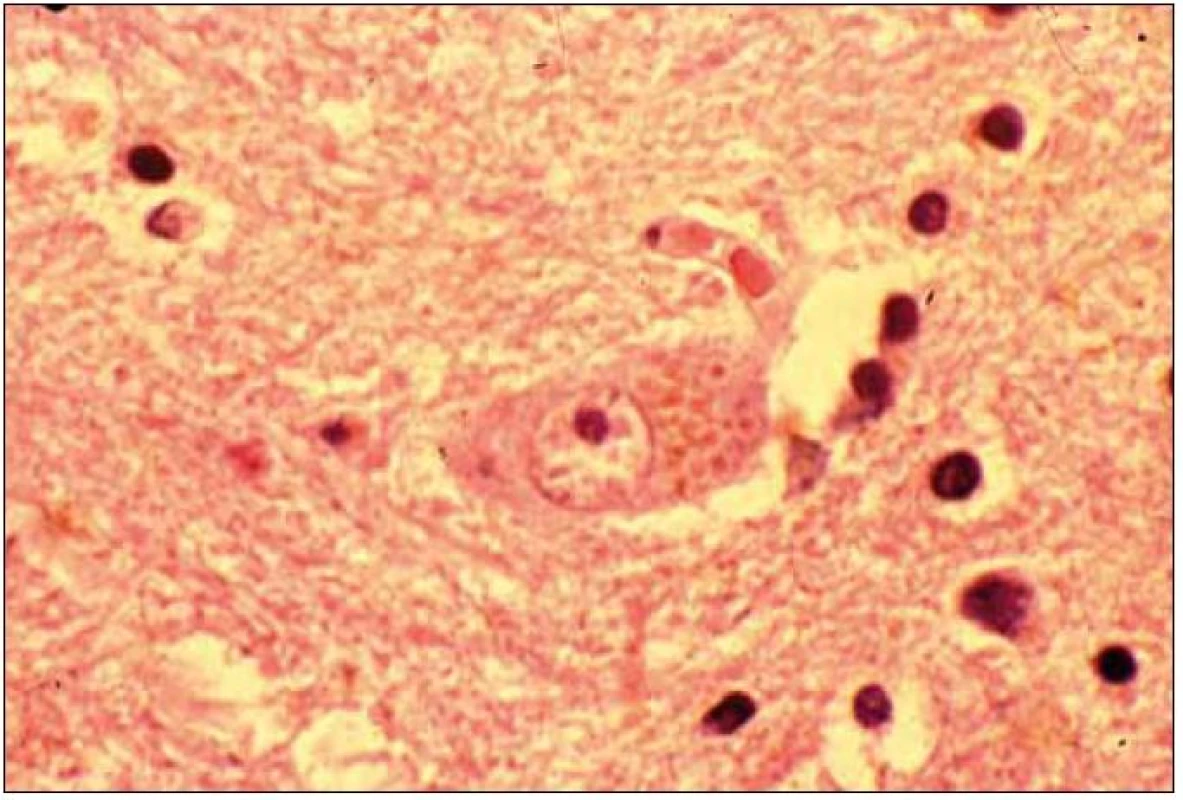 Akumulace lipopigmentu v cytoplazmě zanikajícího neuronu.
Barvení Sudan black.