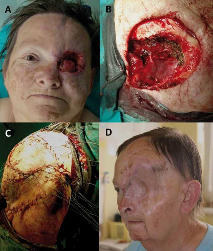 Radikální orbitektomie (B) pro recidivující dlaždicobuněčný karcinom očnice (A) 
s lalokovou plastikou defektu (C) a stav po sedmi letech od operace (D).