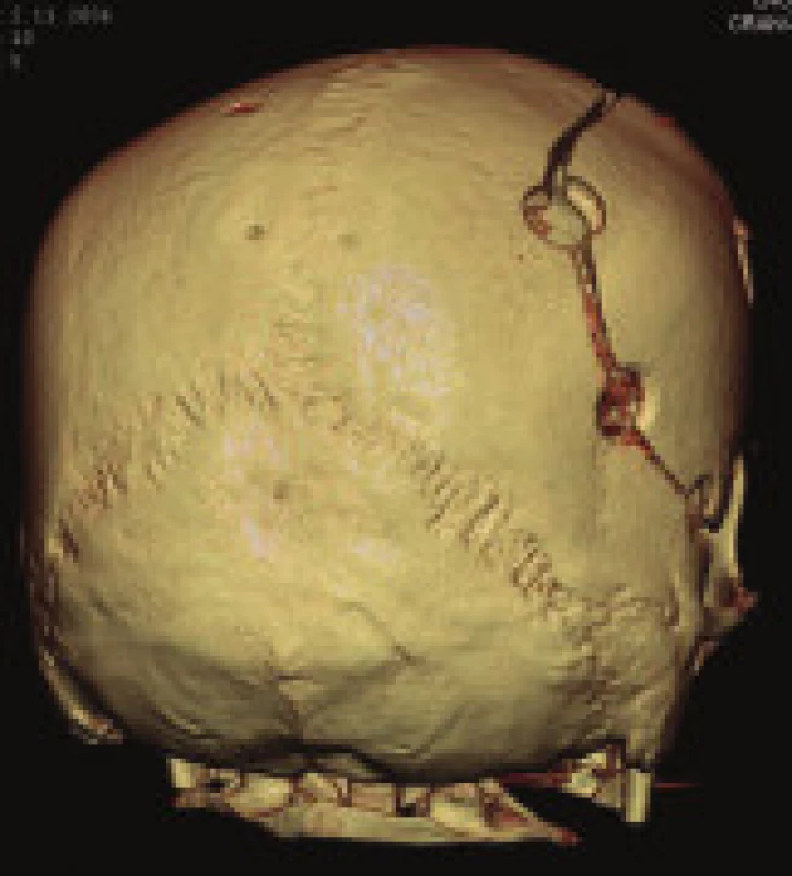 Přiložená kostní ploténka po ústupu edému mozku.