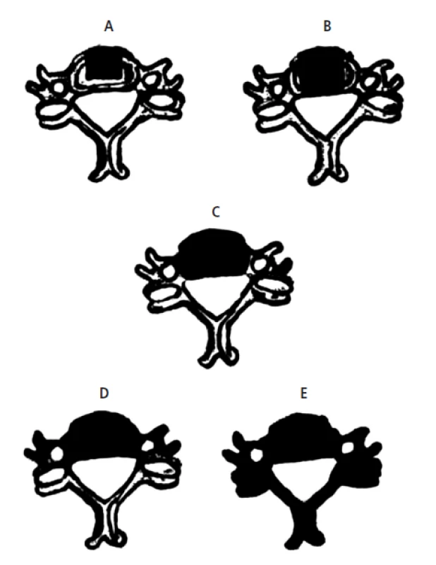 Schéma jednotlivých typů resekce krčního obratle (resekovaná část znázorněna černě): a) parciální omatektomie, b) mediální somatektomie, c) totální somatektomie, d) rozšířená somatektomie, e) totální vertebrektomie (černá barva znázorňuje odstraněné části krčního obratle).