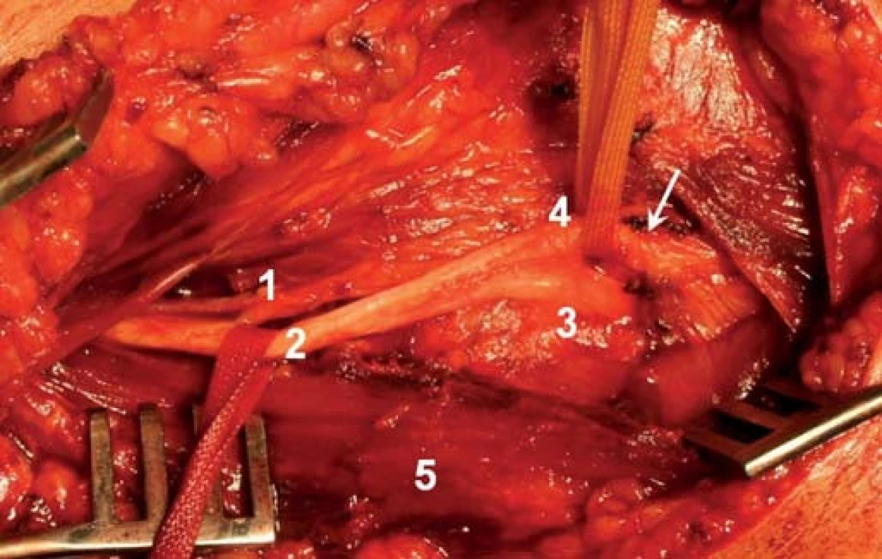 Peroperační snímek před dekompresí NR.
1 – rami musculares, 2 – kmen n. radialis, 3 – r. superficialis, 4 – r. profundus, 5 – m. brachioradialis. Šipka ukazuje Frohseho arkádu.