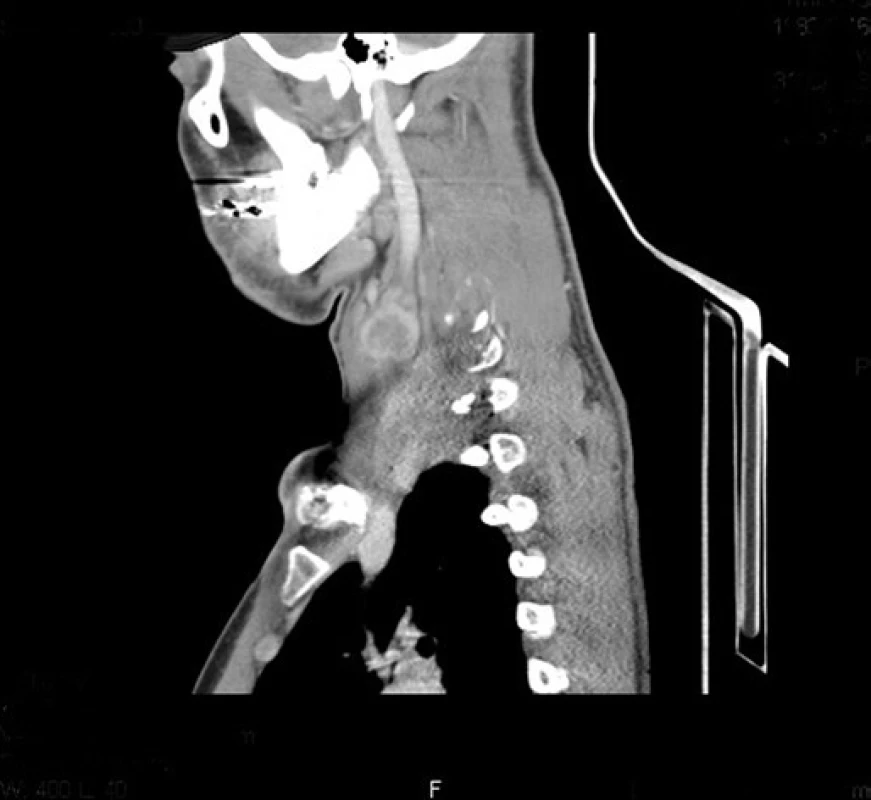 CT angiografie.
Kulovité ložisko v oblasti cervikálního plexu vpravo – sagitální řez.