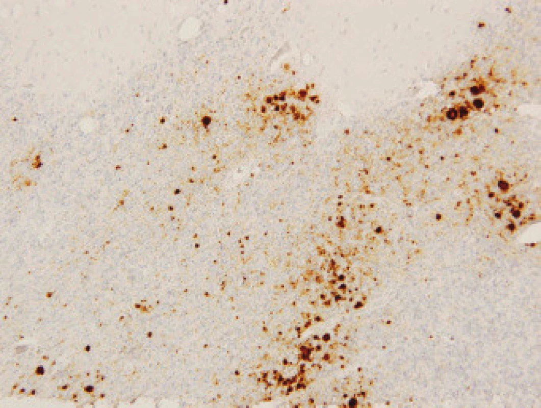 Difusní synaptická a částečně perivakuolární (patchy) pozitivita PrP res s tvorbou nevelkých kuru-like plak v kůře mozečku případu sCJN v imunohistochemické reakci s myší monoklonální protilátkou klonu 6H4 (původní zvětšení 200×).