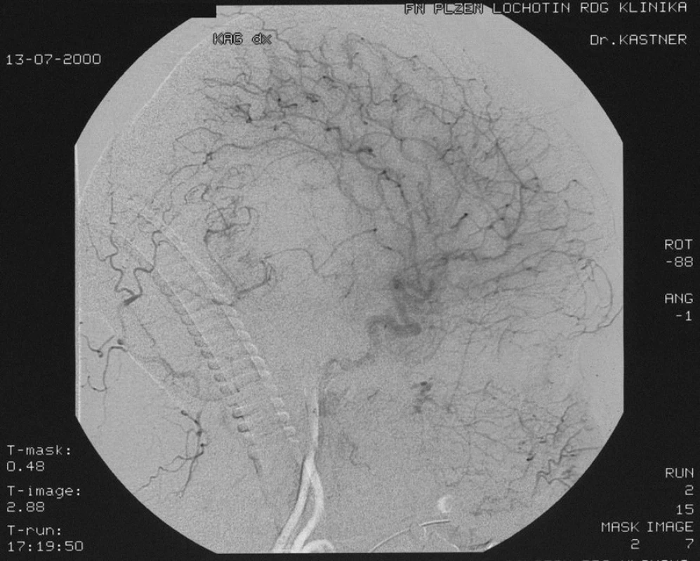 Angiografické vyšetření zobrazilo ložisko patologické vaskularizace parietookcipitálně vpravo, které je částečně zásobeno z povodí art. carotis externa cestou art. occipitalis. Ventrálně od tohoto ložiska je avaskulární zóna.