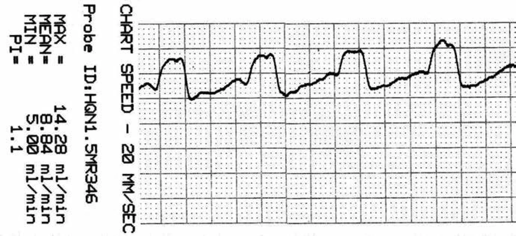 Záznam krevního průtoku v a. temporalis anterior (ATA) před zaklipováním, zachycen průměrný, maximální, minimální průtok a pulzatilní index.