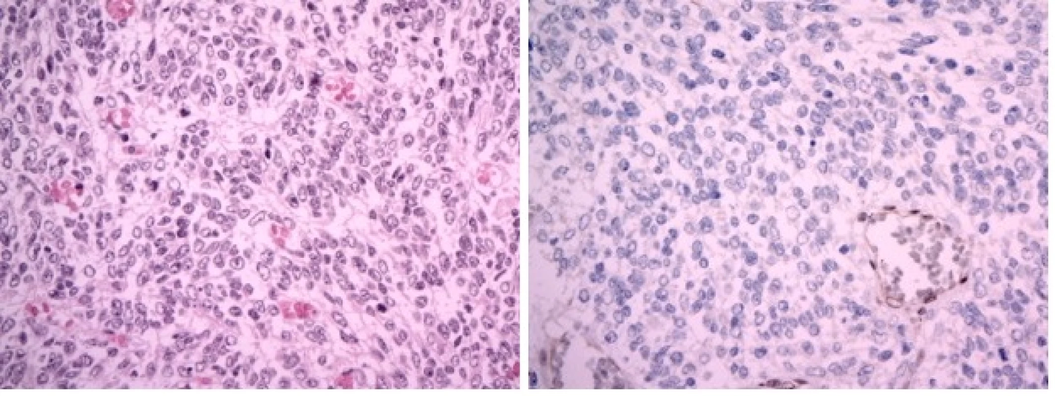 A Atypický teratoidní/rhabdoidní tumor (AT/RT), WHO grade IV. Hypercelulární nádor sestává ze solidně uspořádaných drobných protáhlých buněk s bledou cytoplazmou, které místy svou morfologií a rytmickým uspořádáním připomínaly meduloblastom. V nádoru byly početné mitózy. (hematoxylin-eozin, originální zvětšení x400).
B Imunohistochemický průkaz proteinu INI1 je v nádorových buňkách negativní (při pozitivní vnitřní kontrole v endoteliích, originální zvětšení x400).
Image 2 A Atypical teratoid-rhabdoid tumor (AT/RT), WHO grade IV. Hypercellular tumor containing oval cells with pale cytoplasm arranged in a solid pattern. Their morphology and arrangement resemble cells of medulloblastoma. Numerous mitosis were seen. (H&amp;E x400)
Image 2 B: Imunohistochemical negativity of INI1 protein in tumour cells (retained positivity in endothelial cells, x400)
