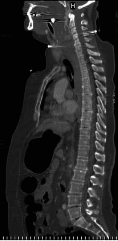 Sagitální rekonstrukce spirálního CT celé páteře ukazující AOD spolu s přerušenou arteria basilaris. Vyšetření provedené v rámci polytraumatického protokolu.