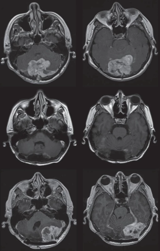 Pacientka s anaplastickým meningiomem po radikální resekci a s výskytem časné recidivy kontralaterálně – na sérii obrázků v dolní části.