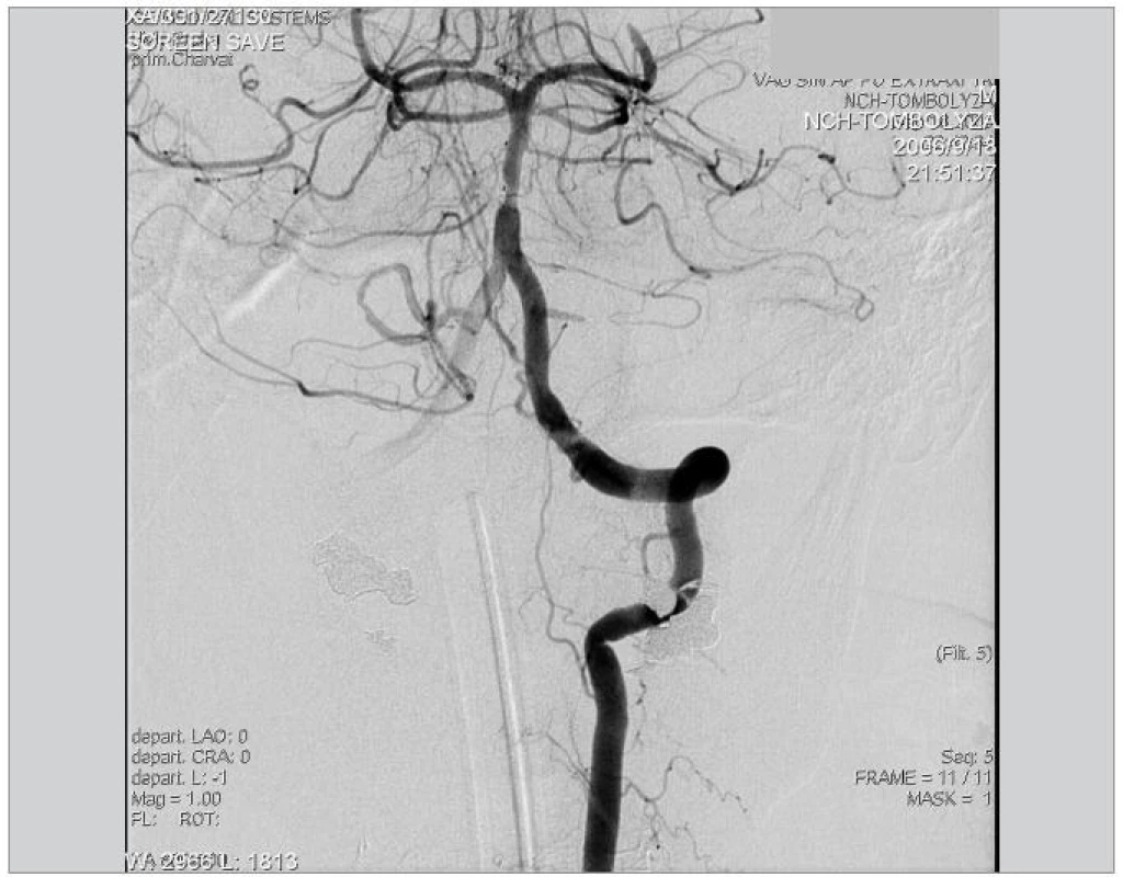 Kontrolní DSA levé AV po embolektomii, nález je výrazně zlepšen. Patrná je stenóza na a. basilaris a reziduální trombus v oblasti P3 a. cerebri posterior vlevo.