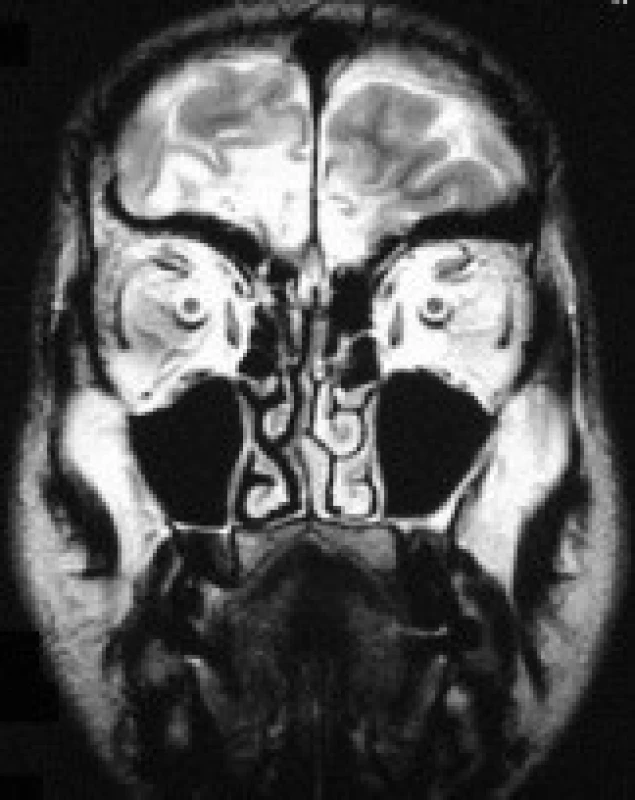 Kazuistika 2: MR mozku, koronární řezy, T2 vážená sekvence u pacienta s poúrazově vzniklou anosmií. Hypersignální ložiska na bazi frontálního laloku vpravo a paramediálně i na bazi levého laloku.