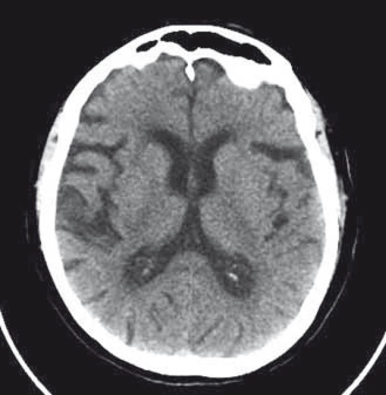 Kontrolní CT mozku (nativ) po 24 hod.
Fig. 2. Control brain CT (unenhanced) after 24 hours.