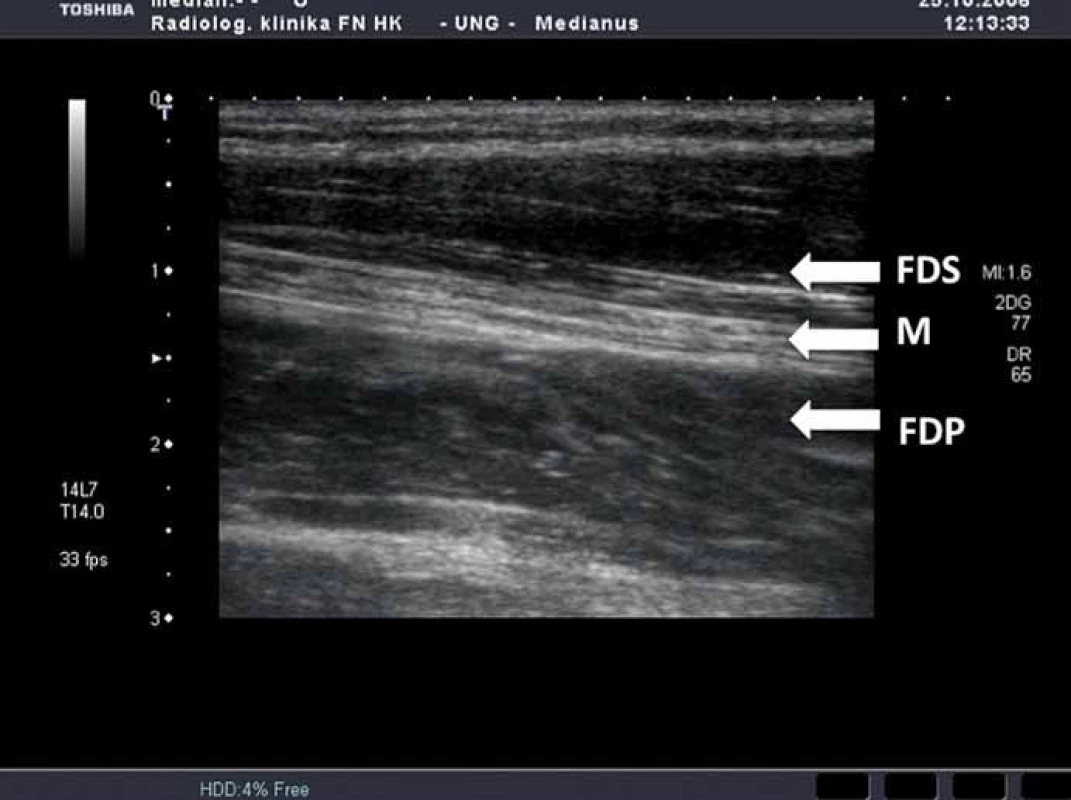 Podélný řez zápěstím na předloktí (FDS – flexor digitorum superficialis, FDP – flexor digitorum profundus, M – nervus medianus).