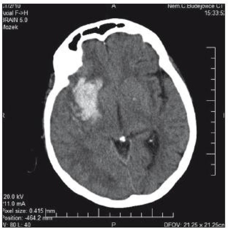 CT mozku: typické hypertonické krvácení v kapsule a bazálních gangliích velikosti 50 × 30 mm s minimálním přetlakem.