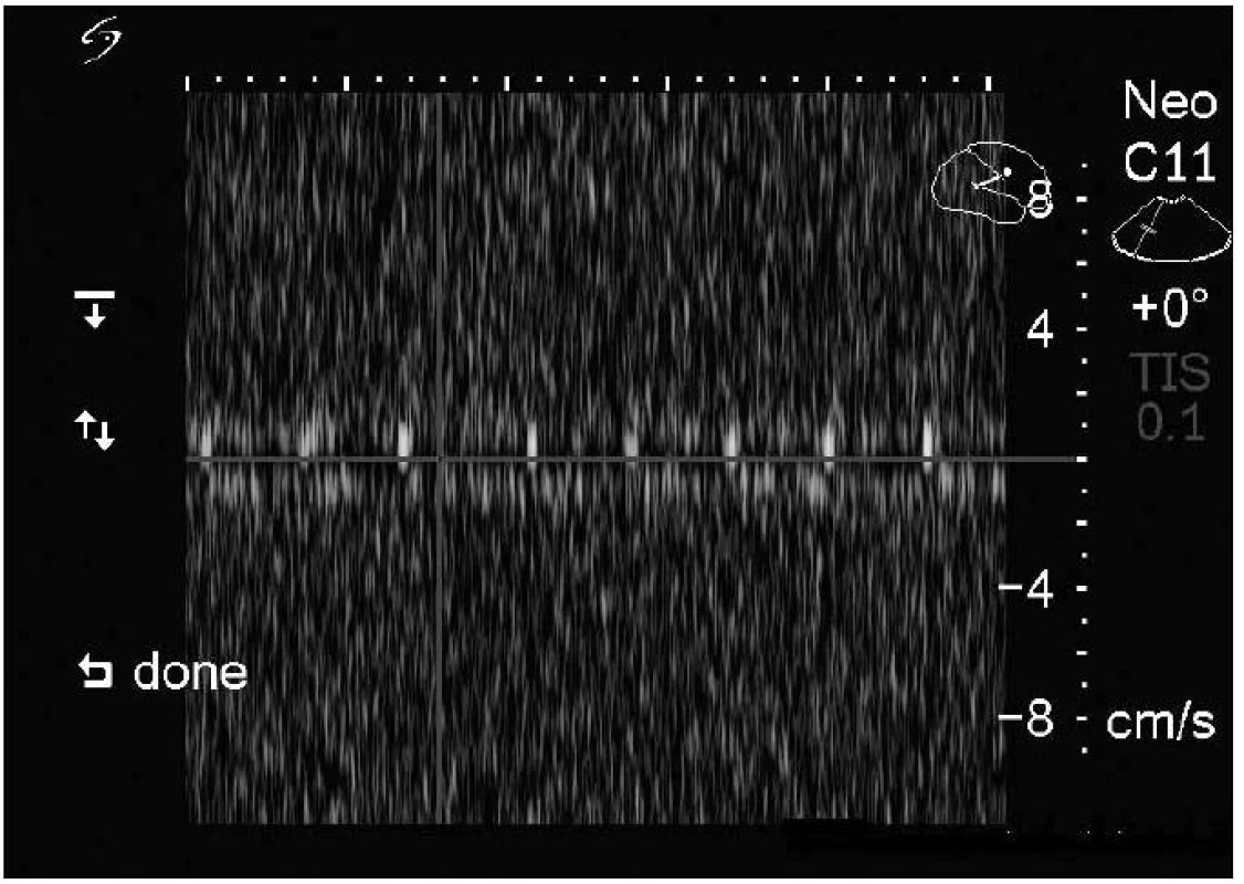 Ultrazvukové vyšetření v dopplerovském modu – blokáda průtoku v cerebrospinální junkci (rychlost toku likvoru 1 cm/s).