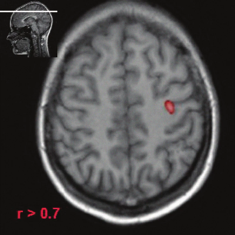 Funkční magnetická rezonance (fMR), použito obvyklé paradigma (pohyby palce ruky), zdravý dobrovolník. Barevně vyznačená area označuje poměrně malé ložisko v oblasti gyrus precentralis, které je korelátem primární motorické arey.