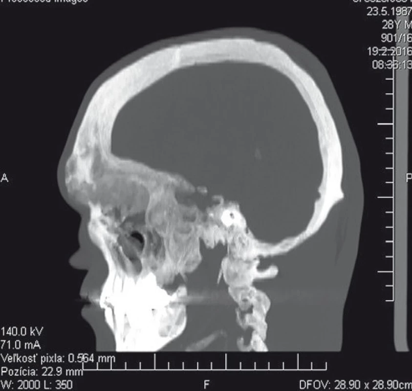 Predoperačné CT vyšetrenie (sagitálny rez) – zrejmé je postihnutie bázy lebečnej, prínosových dutín ako aj hrúbka nádorom zmenených kostných štruktúr.
Fig. 3. Preoperative CT scan (sagittal view) – apparent infiltration of cranial basis and paranasal sinuses as well as evident changes of thickness within tumour-aff ected bone tissue.
