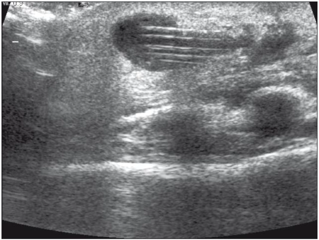 Sonografický nález pseudocysty v peritoneální dutině kolem distální části katétru.