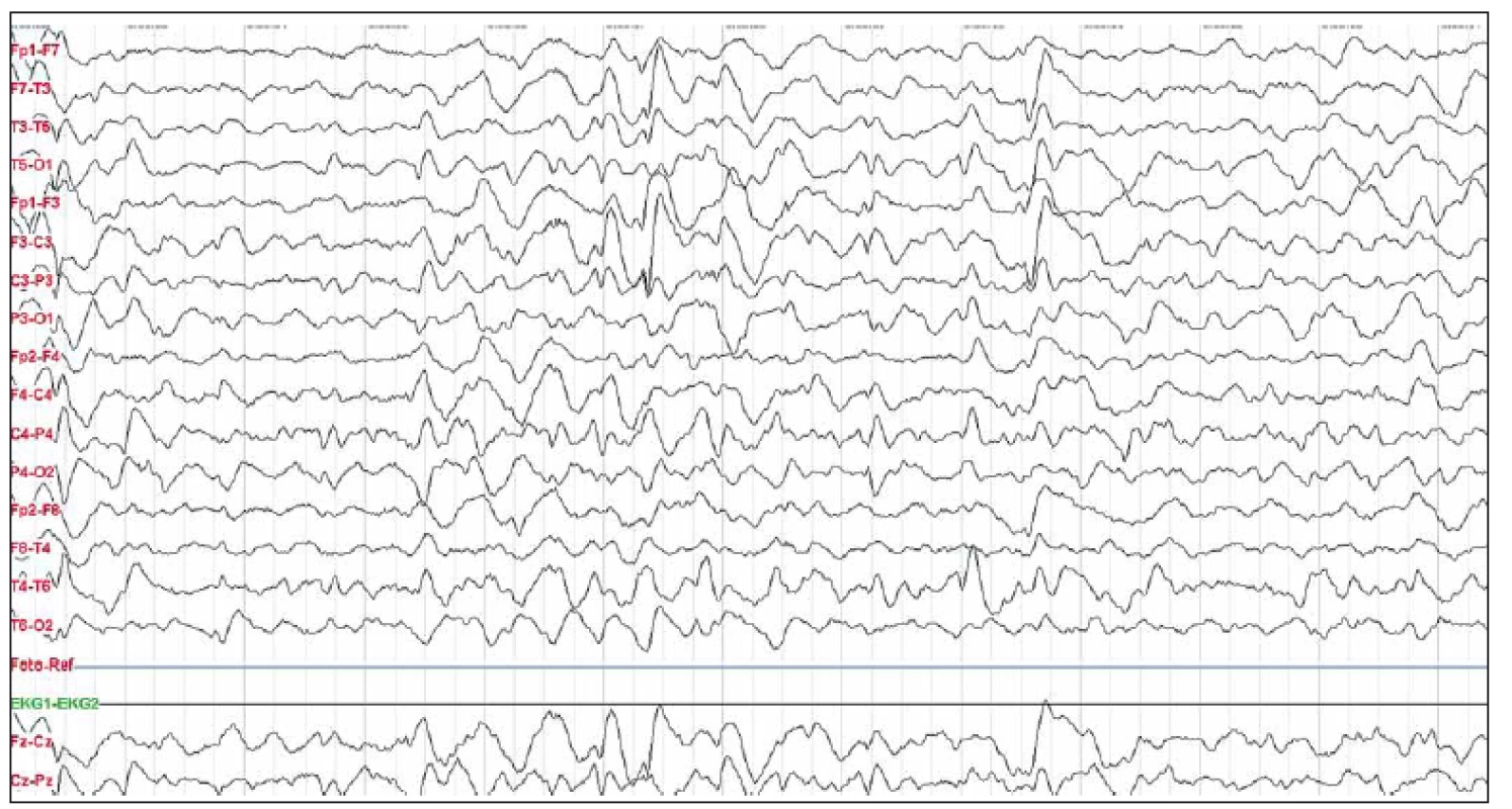 Obr. 4. Pacientka 4 – na EEG nález „extreme delta brushes“ vln.
Fig. 4. Patient 4 – EEG findings of extreme delta brushes waves.