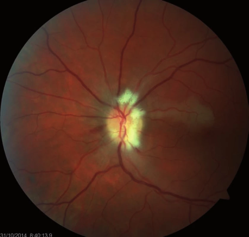 Occlusion of the upper macular branch of the central retinal artery.