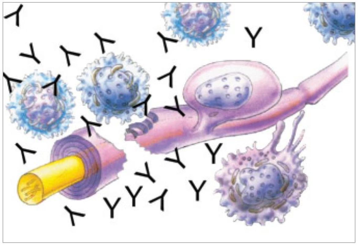 Schematické znázornění interakce plazmocytů s nervovým vláknem, produkce protilátek a axonálního přerušení a demyelinizace