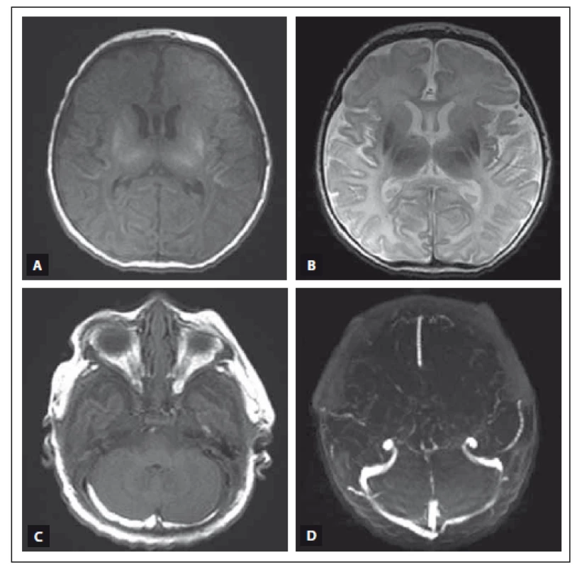 MR vyšetření mozku donošeného novorozence (dívka, gestační věk 41 + 0), postižení bazálních ganglií, thalamů a bílé hmoty mozkové v okcipitálních lalocích při HIE spolu s trombózou sinus transversus oboustranně.
Fig. 3. MRI of a term-neonatal brain (girl, gestational age 41 + 0), pathological lesions in the basal ganglia and thalami, ischemic changes in the white matter of the occipital lobes in a neonate with HIE and trombosis of the both sinus transversus.