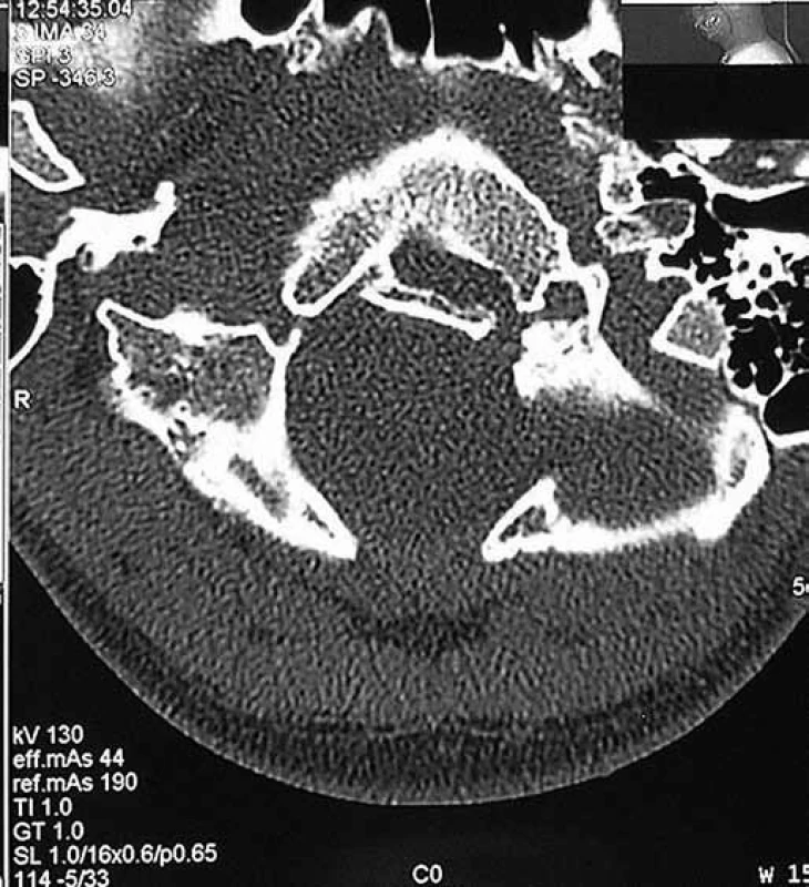 CT obraz po zhojení zlomeniny kondylu okciputu.