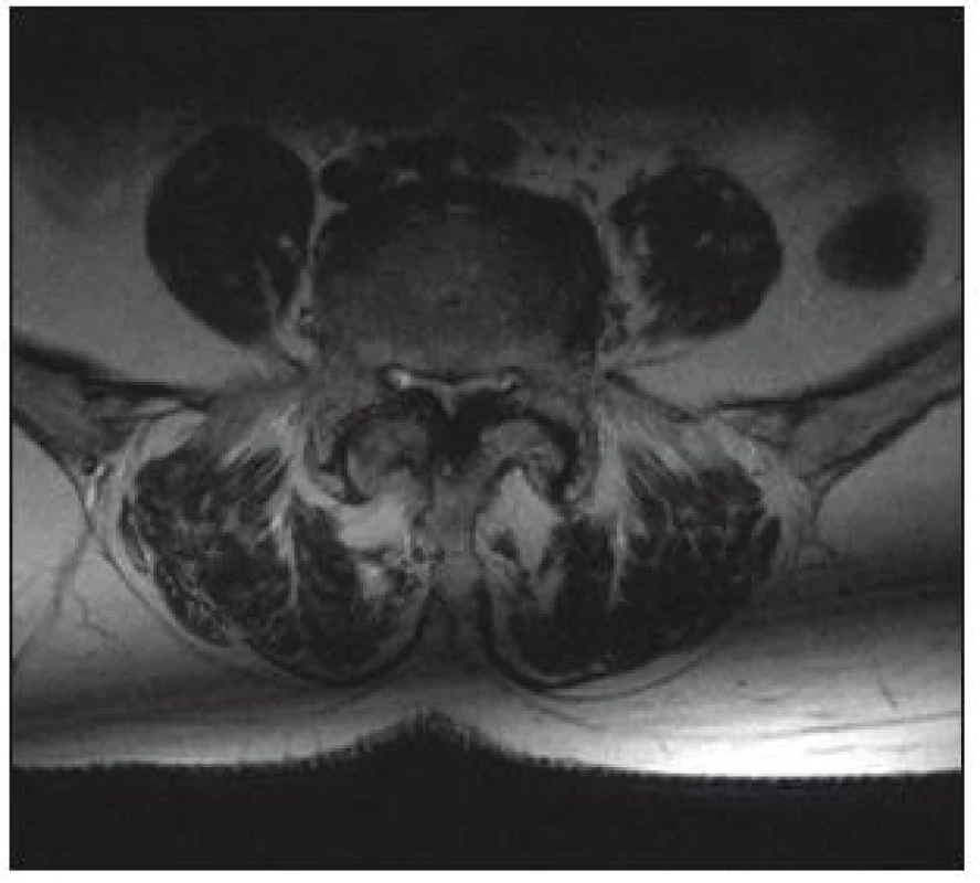 MR bederní páteře v transverzální rovině, T2 vážený obraz. Stenóza páteřního kanálu způsobená artrotickými
změnami facetových kloubů a hypertrofií žlutých vazů.